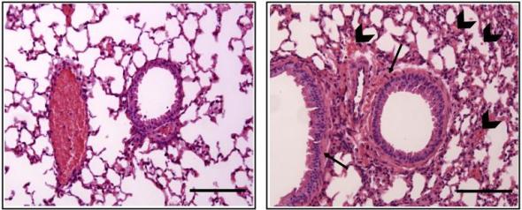 The airways of male (right) and female (left) mice respond differently to anaphylactic triggers. The female response is more severe, showing more accumulation of fluids and cells around the respiratory tract (arrows).