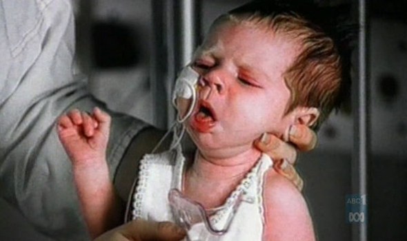 whooping cough