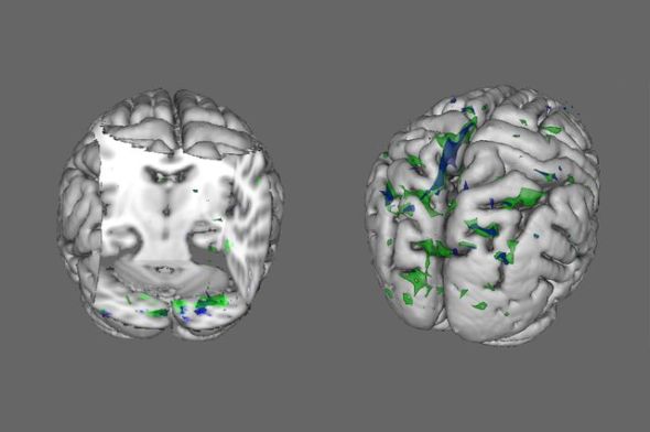 People with anorexia (green areas) and BDD (blue areas) show less activity than healthy people in the brain regions that process “global” information when viewing houses (left) and faces (right). Image credit goes to:  Wei Li, UCLA