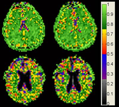 Brain cell density MRI