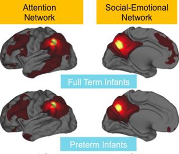 Premature birth appears to weaken brain connections