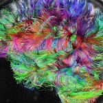 LSD changes consciousness by reorganizing human brain networks