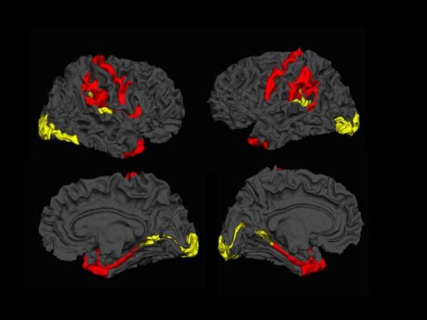 Cortical thickness - schizophrenia