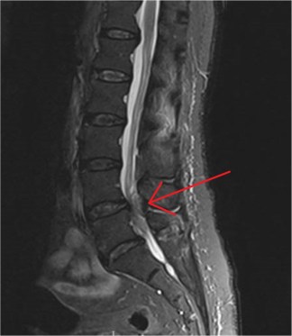 An epidural abscess (Red arrow).
