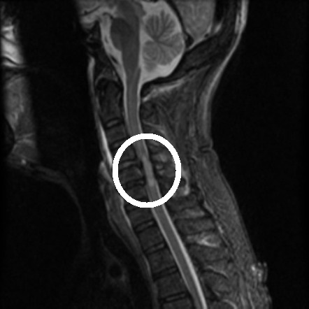 central cord syndrome