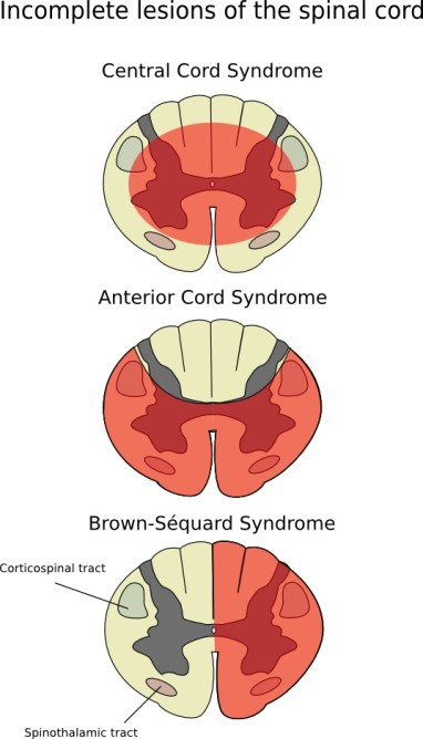 cord lesions