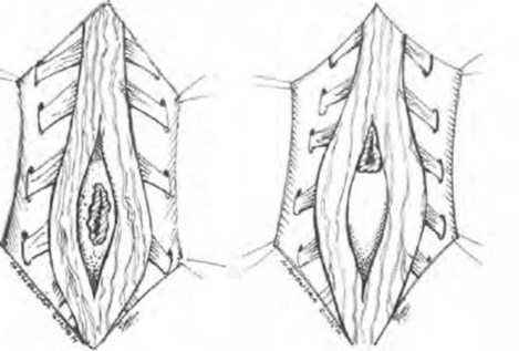 diastematomyelia drawing