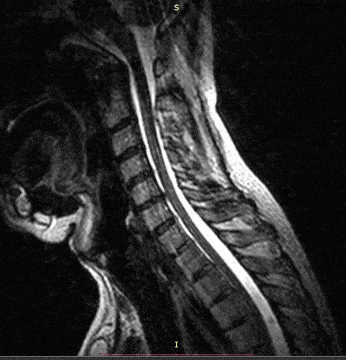spinal cord movement