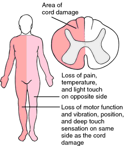 spinal damage