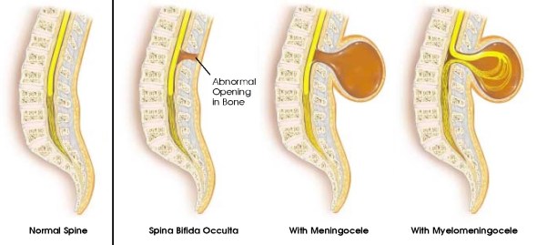 Types of spina bifida