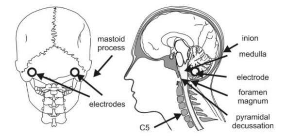 cervicomedullary junction