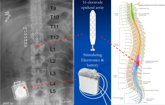 epidural spinal stimulation electrode placement