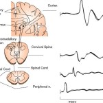Somatosensory Evoked Potentials