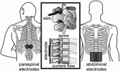 Thoracic transcutaneous spinal cord stimulation electrode placement