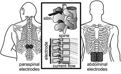 Thoracic transcutaneous spinal cord stimulation electrode placement