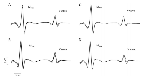 Evoked V-wave responses recorded in a representative participant during 5 repeated maximal voluntary contractions