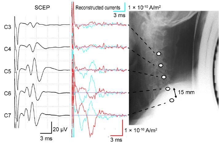 Reconstructed currents of MSG from the cervical spondylotic myelopathy subject. There are two different sets of plots, the furthest left shows the electrophysiological recording taken from the epidural space and the other set shows the reconstructed currents using MSG. They agree fairly well.