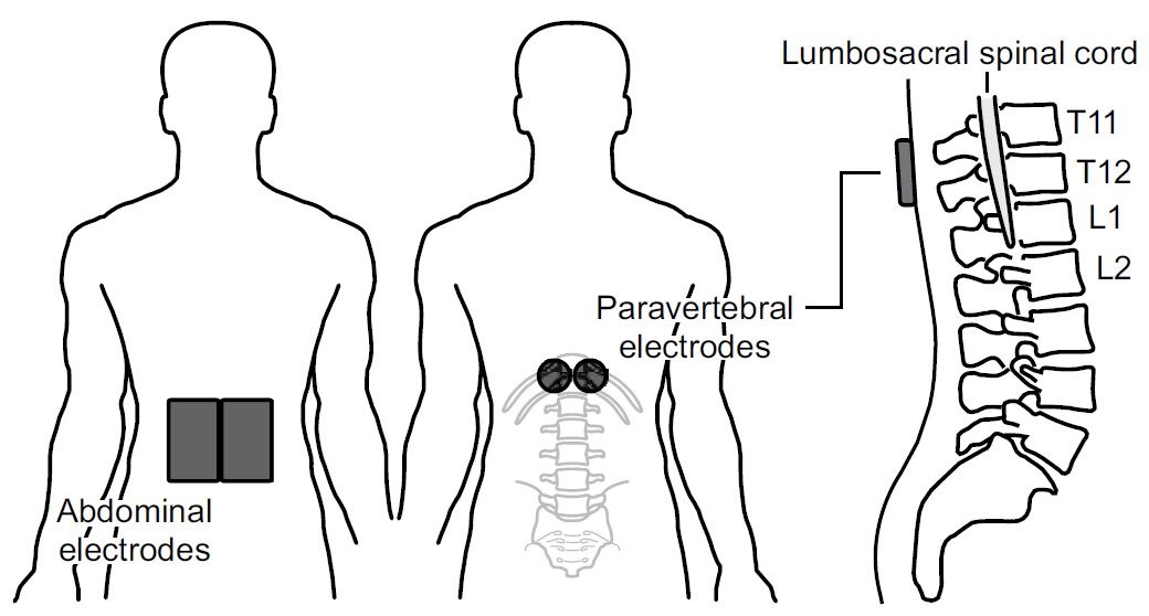 Black and white diagram showing the front and back of a human with the the placement of electrodes over the lower abdominal area and  separate electrodes over T11-T12 of the spinal cord a third image to the right shows the side of the spinal column with spinal cord to depict the location of the back electrodes with relation to the spinal cord