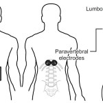 Black and white diagram showing the front and back of a human with the the placement of electrodes over the lower abdominal area and separate electrodes over T11-T12 of the spinal cord a third image to the right shows the side of the spinal column with spinal cord to depict the location of the back electrodes with relation to the spinal cord