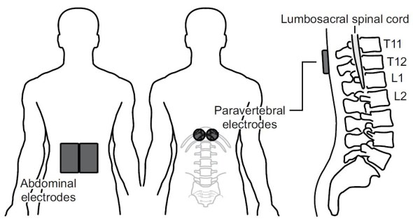 Black and white diagram showing the front and back of a human with the the placement of electrodes over the lower abdominal area and separate electrodes over T11-T12 of the spinal cord a third image to the right shows the side of the spinal column with spinal cord to depict the location of the back electrodes with relation to the spinal cord